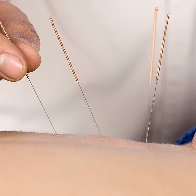 Acupuncture-in-York-Square Acupuncture-in-York