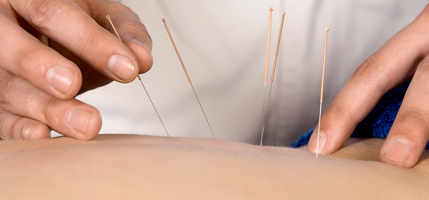 Acupuncture-in-York