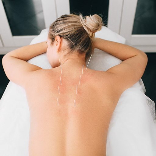 Acupuncture-in-York